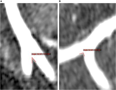 Vertebrobasilar Junction Angle Over 90°: A Potential Imaging Marker Associated With Vertebrobasilar Atherosclerosis